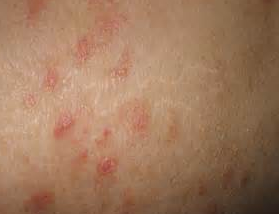 银屑病早期有哪些症状呢