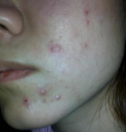 郑州脸上长痘痘的正确洗脸方法