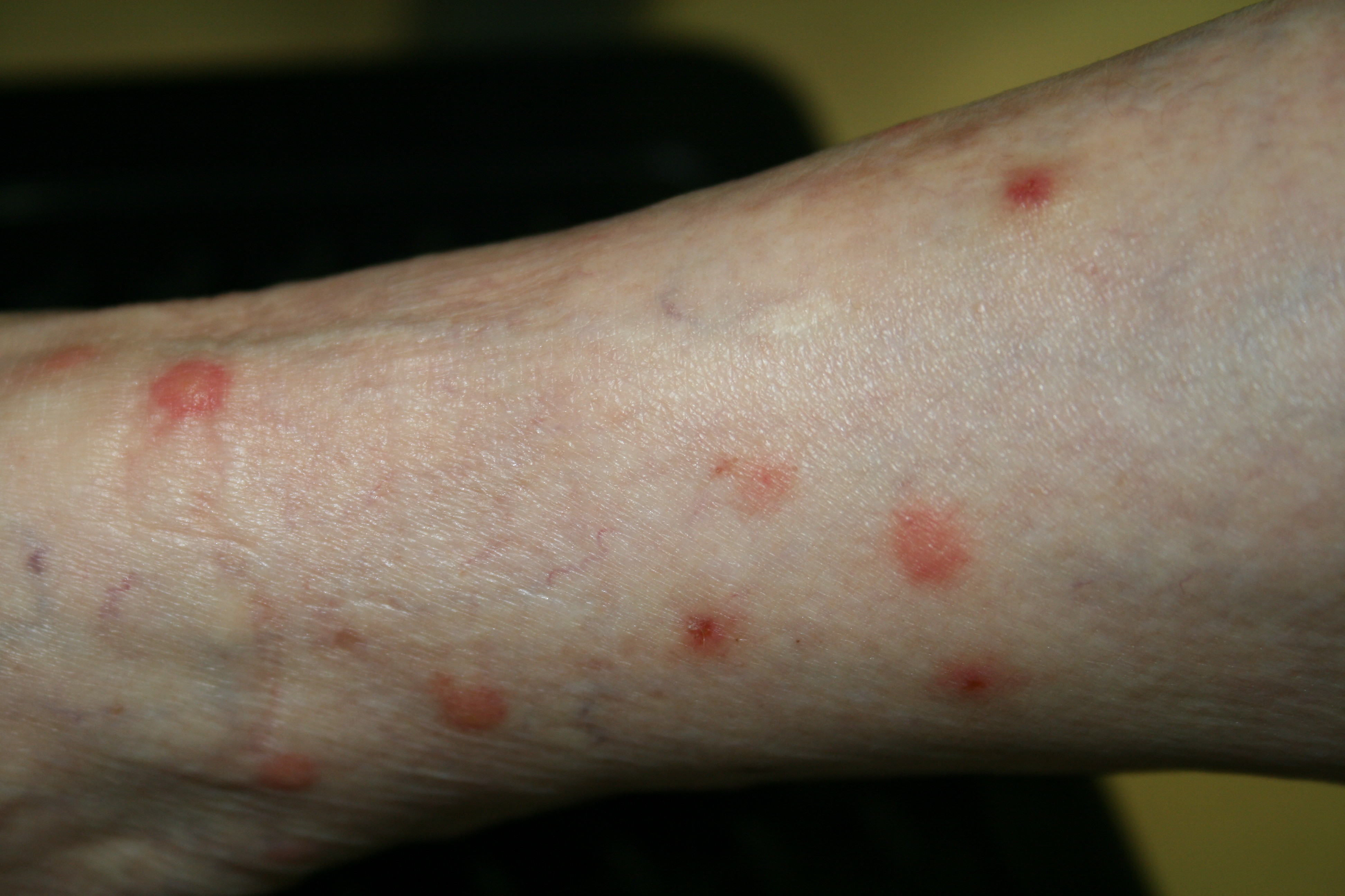 郑州湿疹患者不能吃什么