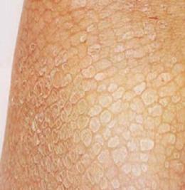 郑州鱼鳞病患者怎样吃鸡蛋才健康