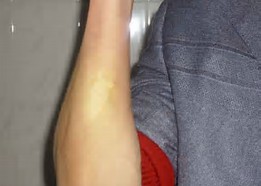 郑州脸上长白斑是白癜风怎么办