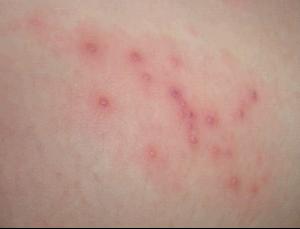 郑州急性湿疹患者要如何预防病情的发生 