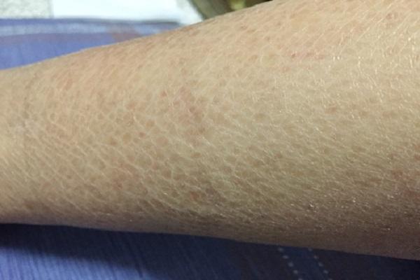 郑州鱼鳞病患者的日常注意事项有哪些