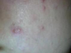 郑州痤疮患者在生活中需要注意什么