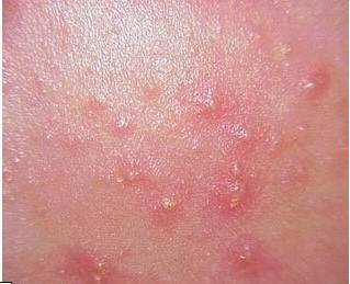 郑州如果脸上长有青春痘怎么办 