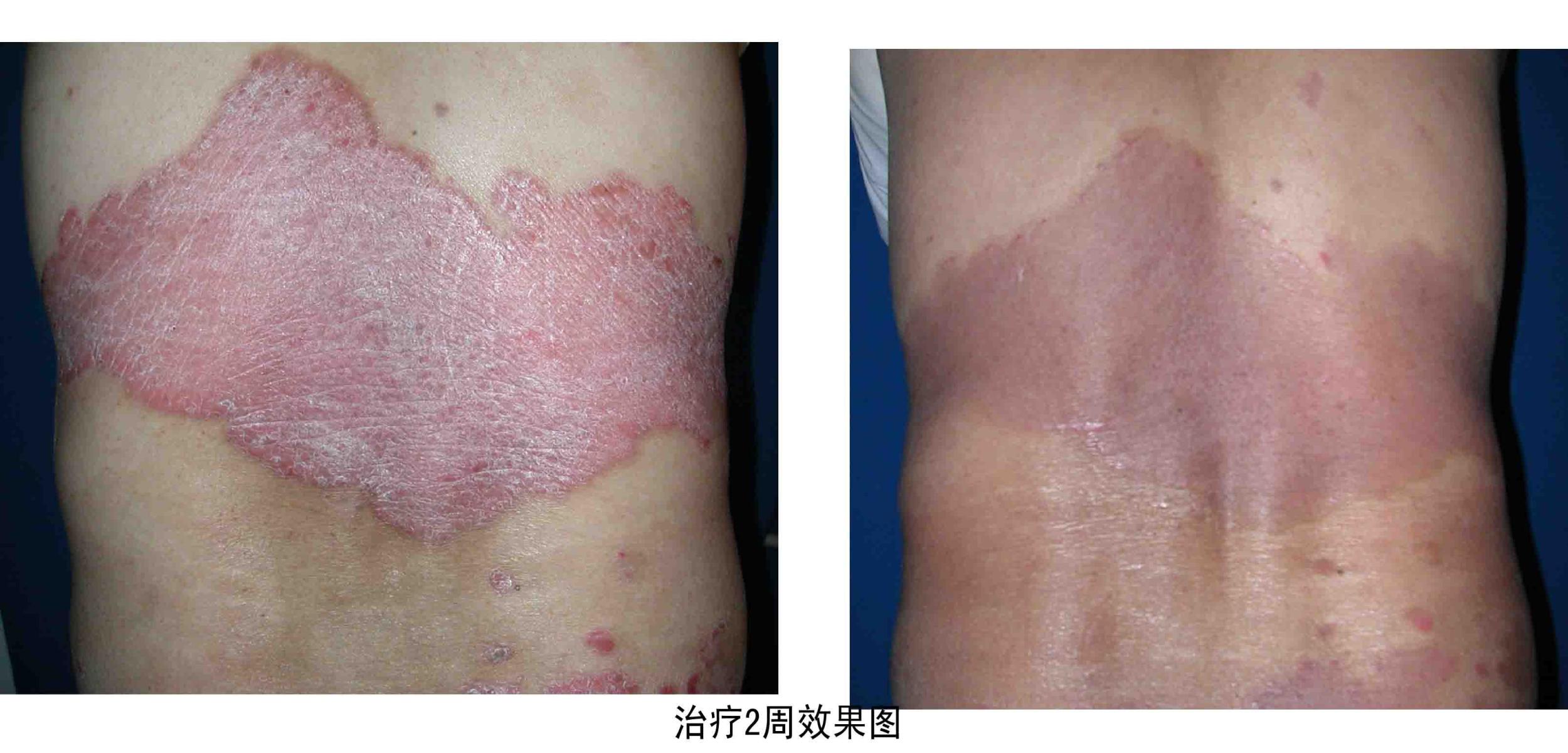 郑州哪家医治银屑病专科好