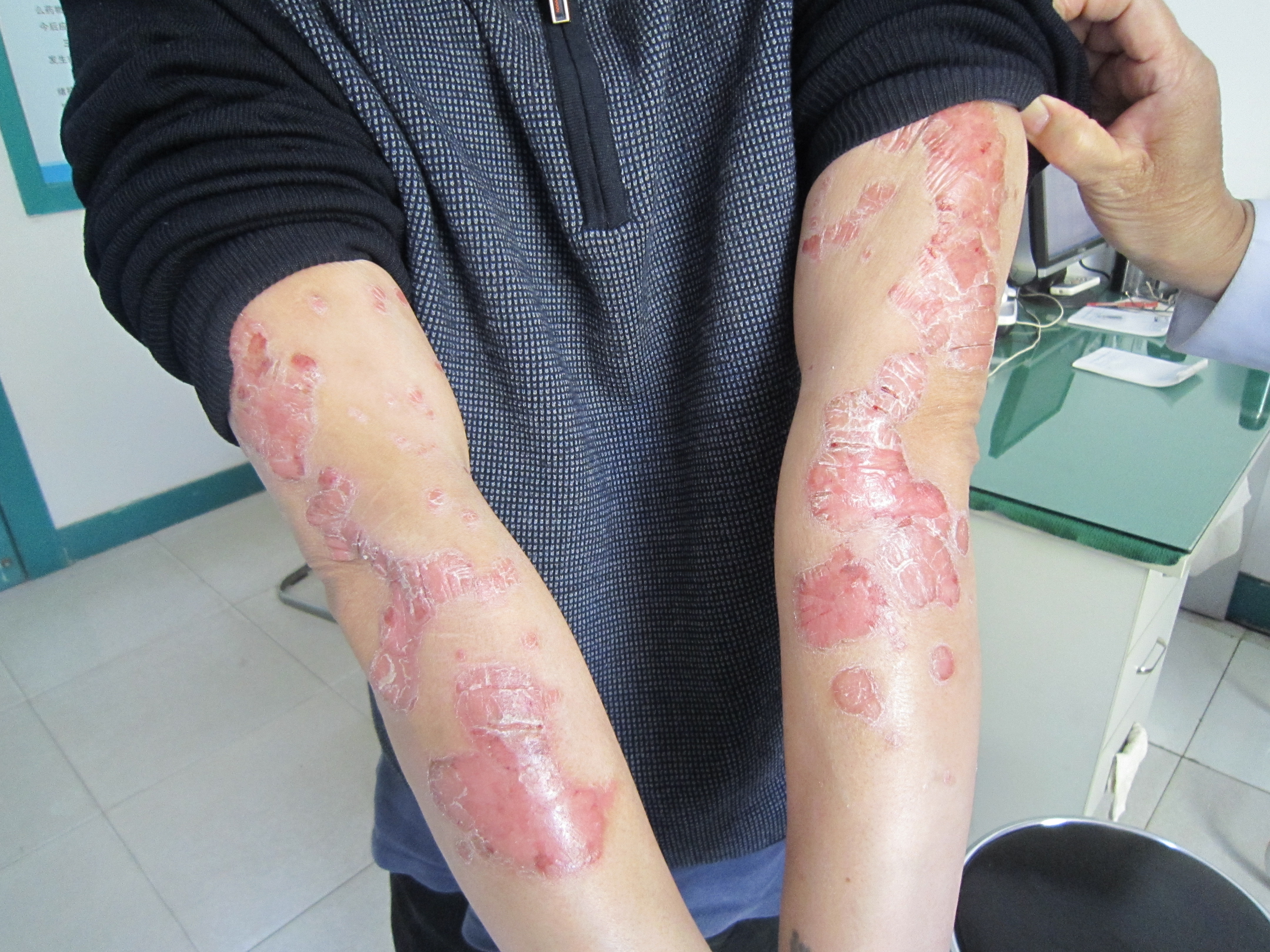 郑州治疗银屑病的价格怎么样