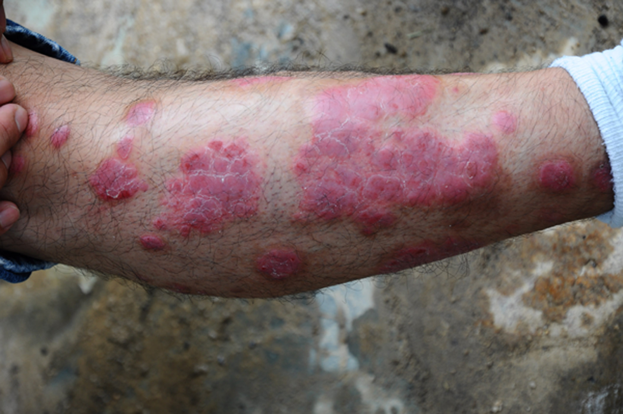 郑州治疗牛皮癣专科哪家比较好