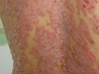 郑州治牛皮癣比较好的专科是哪家