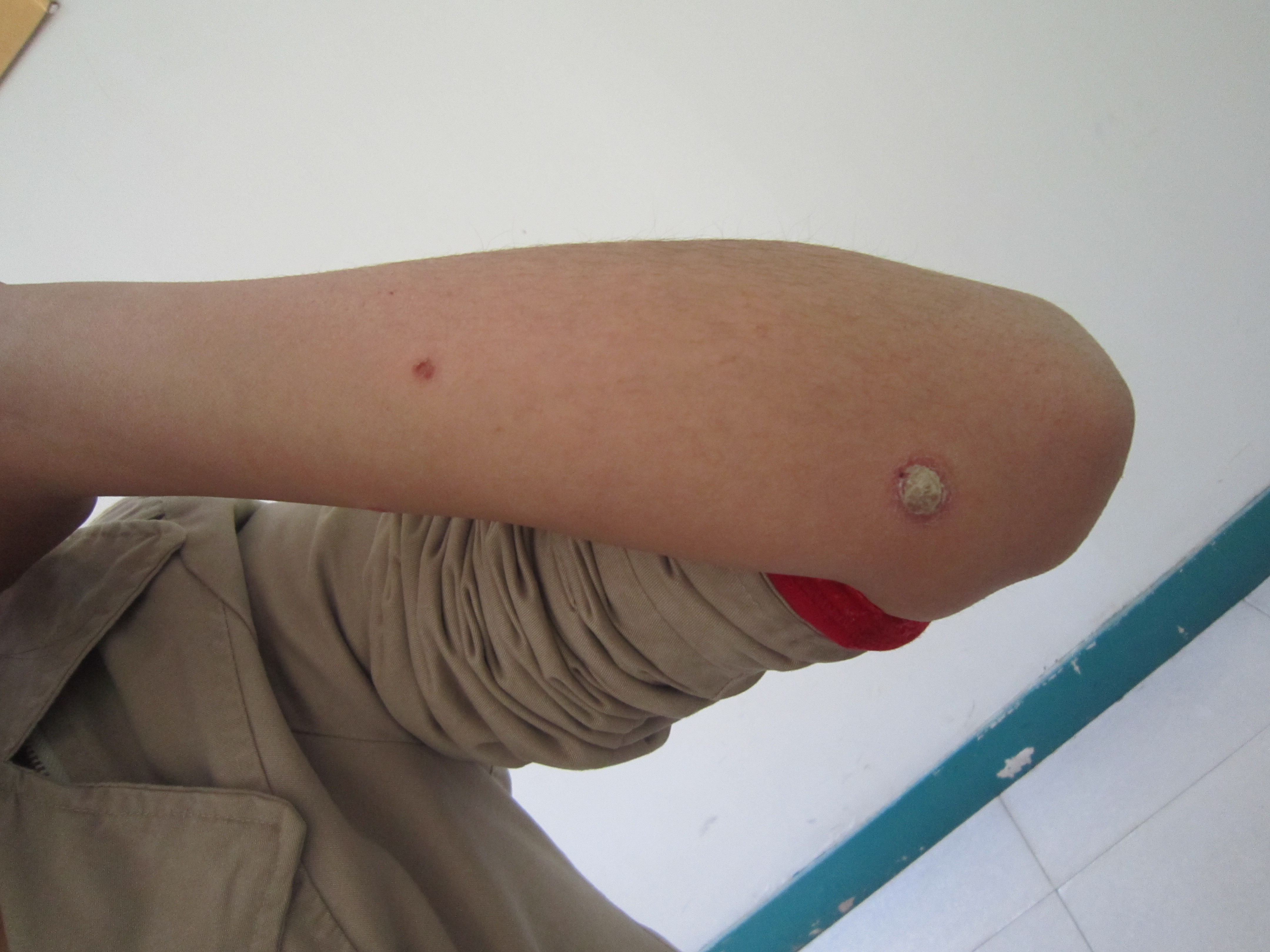 郑州治疗牛皮癣专科哪里好