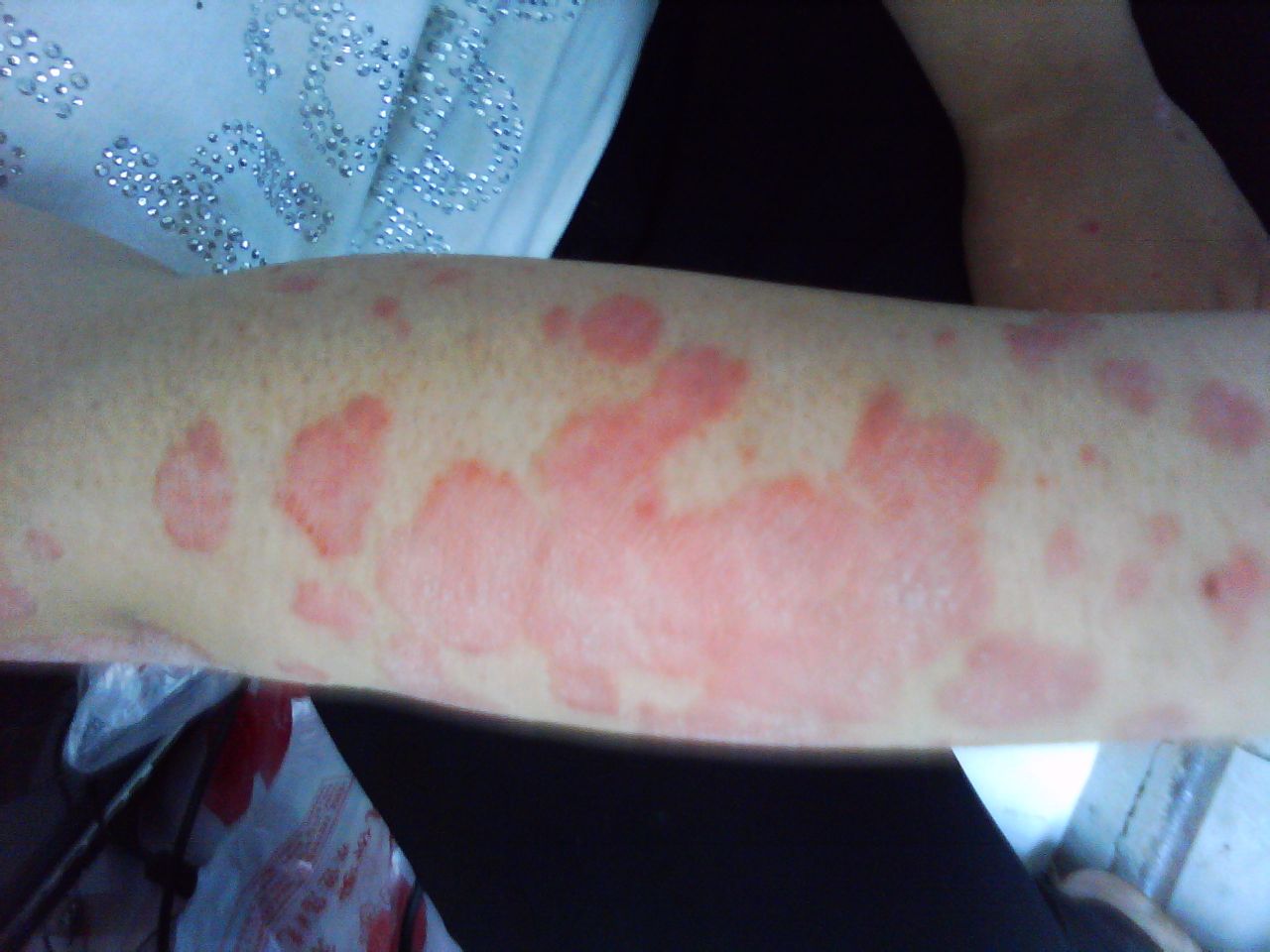 郑州头部牛皮癣护理要注意什么 