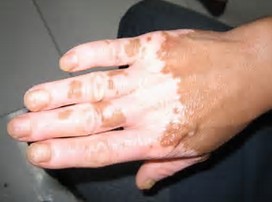 郑州面部患有白癜风有哪些原因