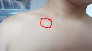 郑州去哪家专科治疗白癜风